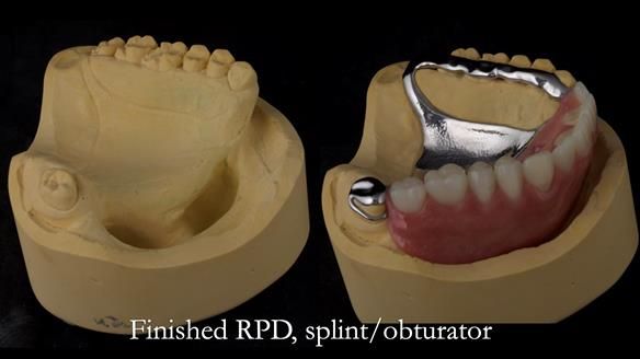 Upper metal base partial denture/occlusal stabilisation splint/obturator - full protocol