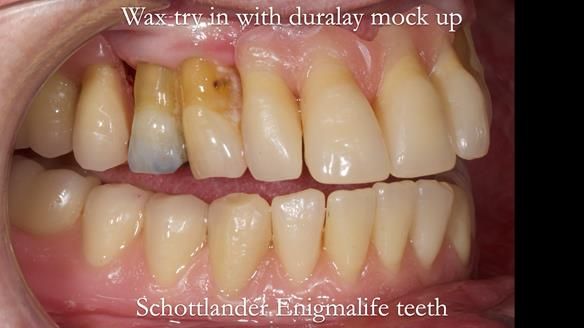 Finlay's Newsletter 59 Ultra hard partial dentures made for Gill