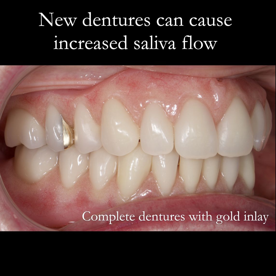 Saliva flow and new dentures