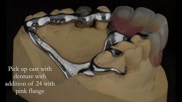 Finlay's Newsletter 63 Case study provision of metal based Scandinavian RPD - functional 10 years on