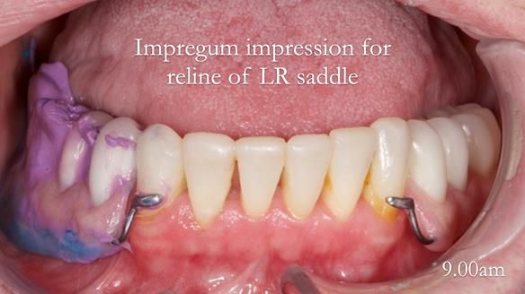 Newsletter 52 Managing Jo’s failing dentition with extractions and Mk 1/Mk 2 complete upper dentures and lower partial dentures FULL PROTOCOL