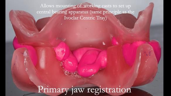 Finlay's Newsletter 62 provision of extractions and metal based complete dentures for Rafique