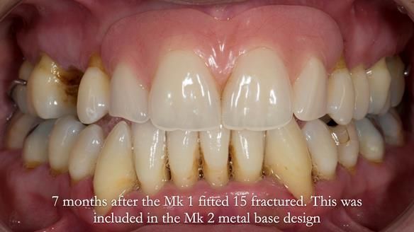 Finlay's Newsletter 63 Case study provision of metal based Scandinavian RPD - functional 10 years on