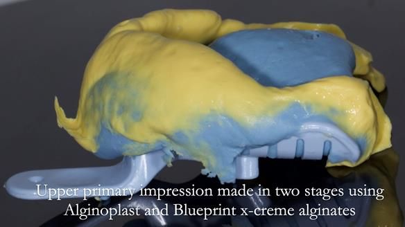 Newsletter 54 case presentation upper complete denture and lower Scandinavian designed hygienic partial denture for David