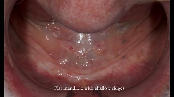 Newsletter 83: Sheila’s Complete Denture Success
