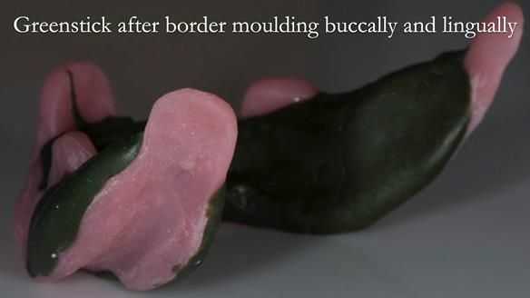 Newsletter 75: Marion’s case - Step-by-step complete denture workflow