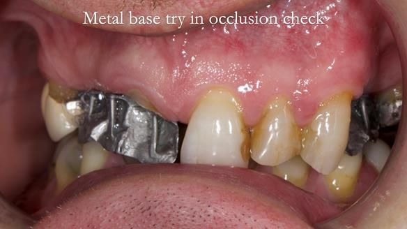 Read Newsletter 67 - Brian's COMBAT DENTURE Case Study
