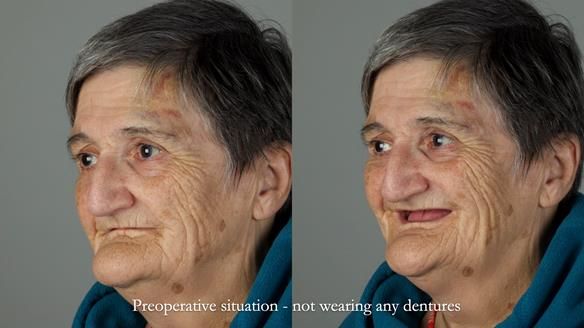 Newsletter 83: Sheila’s Complete Denture Success