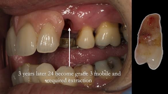 Finlay's Newsletter 63 Case study provision of metal based Scandinavian RPD - functional 10 years on