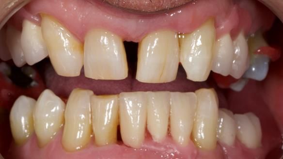 Newsletter 86 Peter the Architect — precision removable partial dentures case study