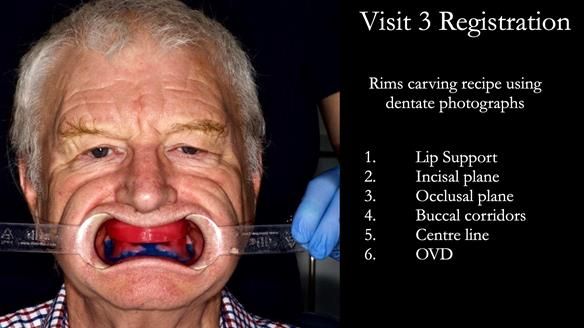 Newsletter 57 showcases the making and fitting process of implant-supported complete dentures for Alisdair