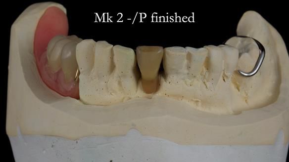Newsletter 54 case presentation upper complete denture and lower Scandinavian designed hygienic partial denture for David