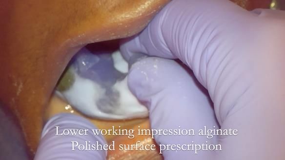 Newsletter 53 showing the making and fitting of ultra life-like dentures for Valena