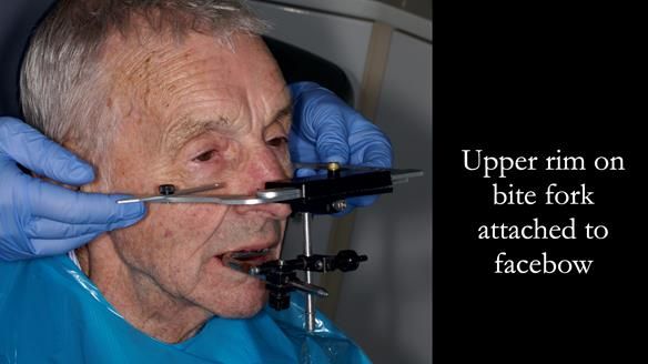 Newsletter 80 - Gordon’s dentures: the one case in 1,000 where my technique failed