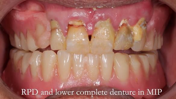 Finlay's Newsletter 62 provision of extractions and metal based complete dentures for Rafique
