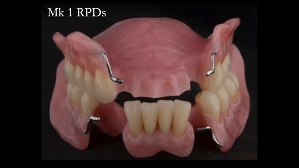 Finlay's Case Study Newsletter 40 - Immediate Mk 1 RPD to Definitive Mk 2 RPD - full protocol