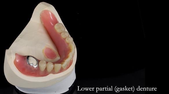 Newsletter 82 Mary - A complete upper and a one-tooth gasket denture