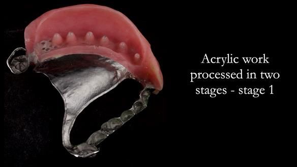Upper metal base partial denture/occlusal stabilisation splint/obturator - full protocol