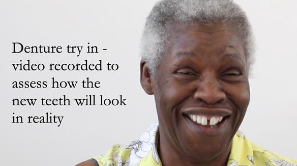 Newsletter 53 showing the making and fitting of ultra life-like dentures for Valena