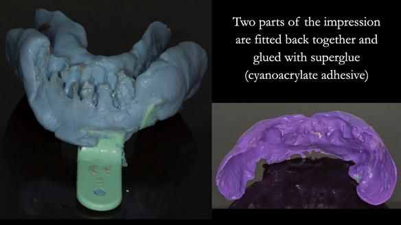 Finlay's Case Study Newsletter 40 - Immediate Mk 1 RPD to Definitive Mk 2 RPD - full protocol