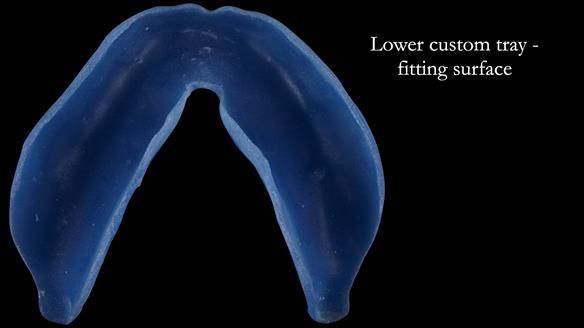 Newsletter 53 showing the making and fitting of ultra life-like dentures for Valena