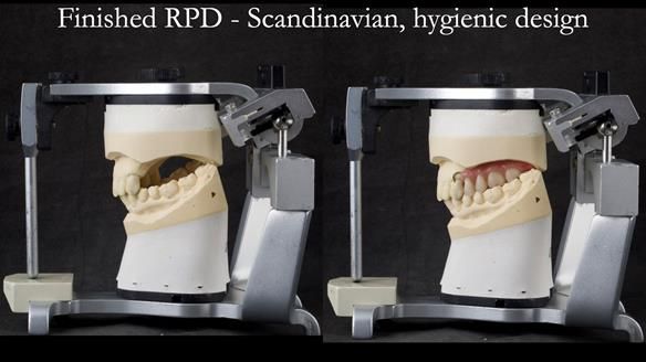 Solving Sue's failed implants with metal based RPD - full protocol Newsletter 43