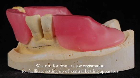 Finlay's Newsletter 59 Ultra hard partial dentures made for Gill