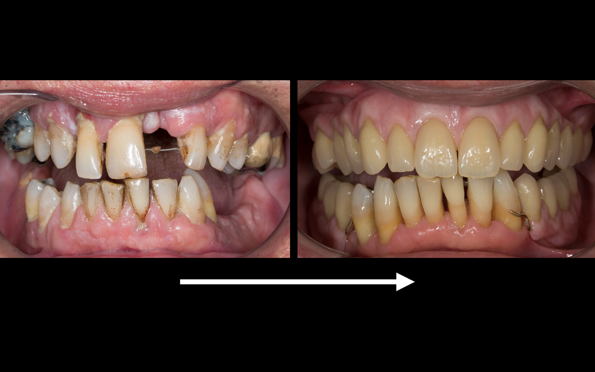 Figure 120 Before treatment and after treatment with Mk 2 maxillary cobalt chromium based complete denture and mandibular cobalt chromium based partial denture fitted. Periodontal therapy including surgery by Syed Abad, Specialist in Periodontics.