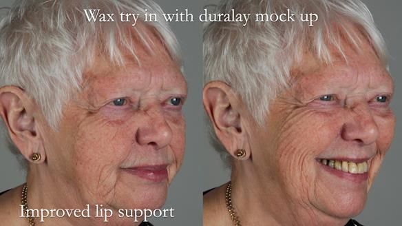 Finlay's Newsletter 59 Ultra hard partial dentures made for Gill