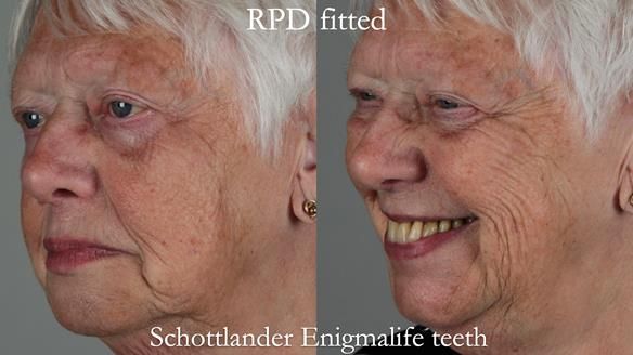 Finlay's Newsletter 59 Ultra hard partial dentures made for Gill