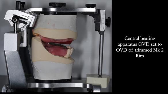 Newsletter 52 Managing Jo’s failing dentition with extractions and Mk 1/Mk 2 complete upper dentures and lower partial dentures FULL PROTOCOL