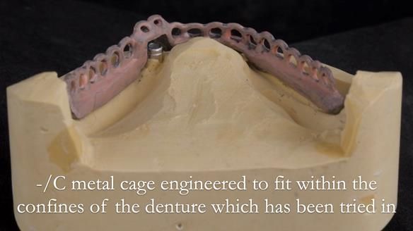Managing poor implant positioning with complete dentures and Locator attachments - full protocol Newsletter 41