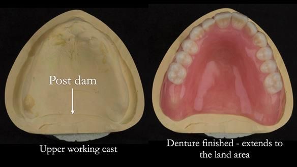 Newsletter 75: Marion’s case - Step-by-step complete denture workflow