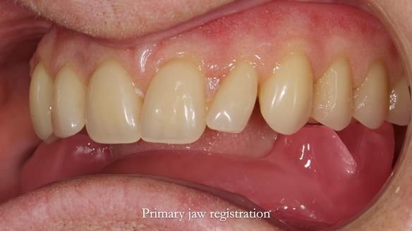 Newsletter 82 Mary - A complete upper and a one-tooth gasket denture