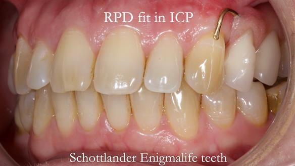 Solving Sue's failed implants with metal based RPD - full protocol Newsletter 43