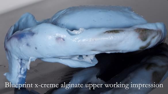 Newsletter 53 showing the making and fitting of ultra life-like dentures for Valena