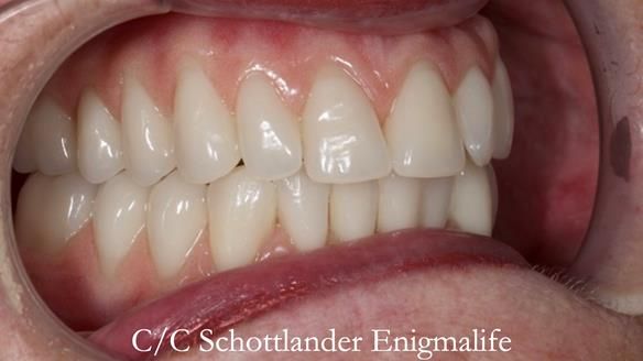 Replacing Madeline’s Complete denture FULL PROTOCOL