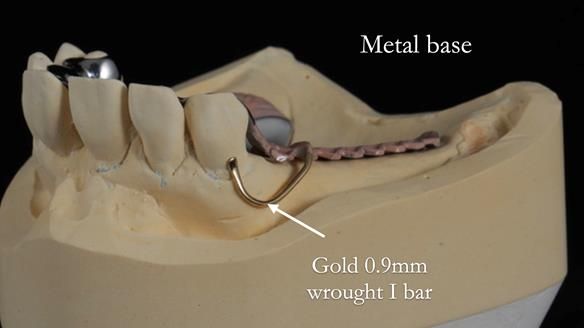 Newsletter 56 showing the making and fitting of a bilateral free end saddle upper removable partial denture (RPD) for patient with pemphigus