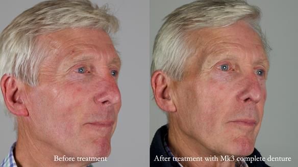 Newsletter 77: Jeremy’s case – immediate complete upper denture