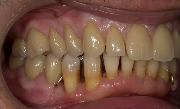 Figure 116 Mk 2 finished dentures fitted with 0.9 mm wrought gold clasps on LR4 and LL3