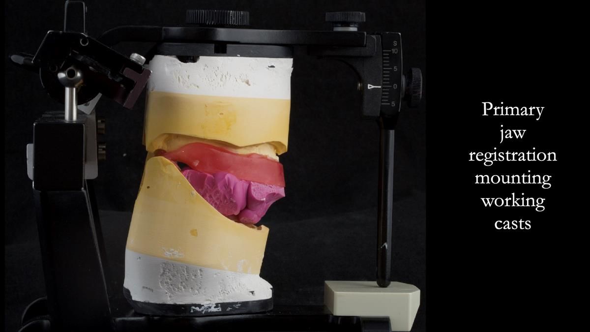 Fin’s Newsletter 88 — Complete dentures - full protocol… he rearranged his own teeth!