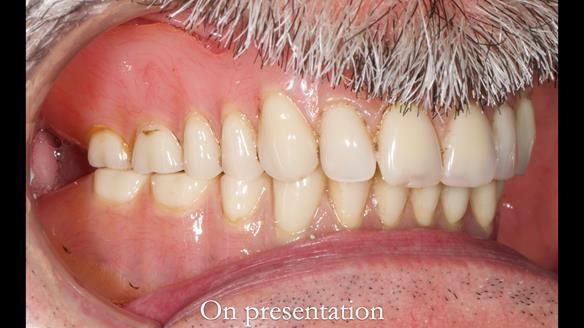 Newsletter 78: What do Clark Gable and a Locator® overdenture have in common?