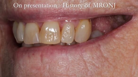 Finlay's Newsletter 60 Sylvia's upper Kennedy Class 2 Mod 1 metal based upper RPD