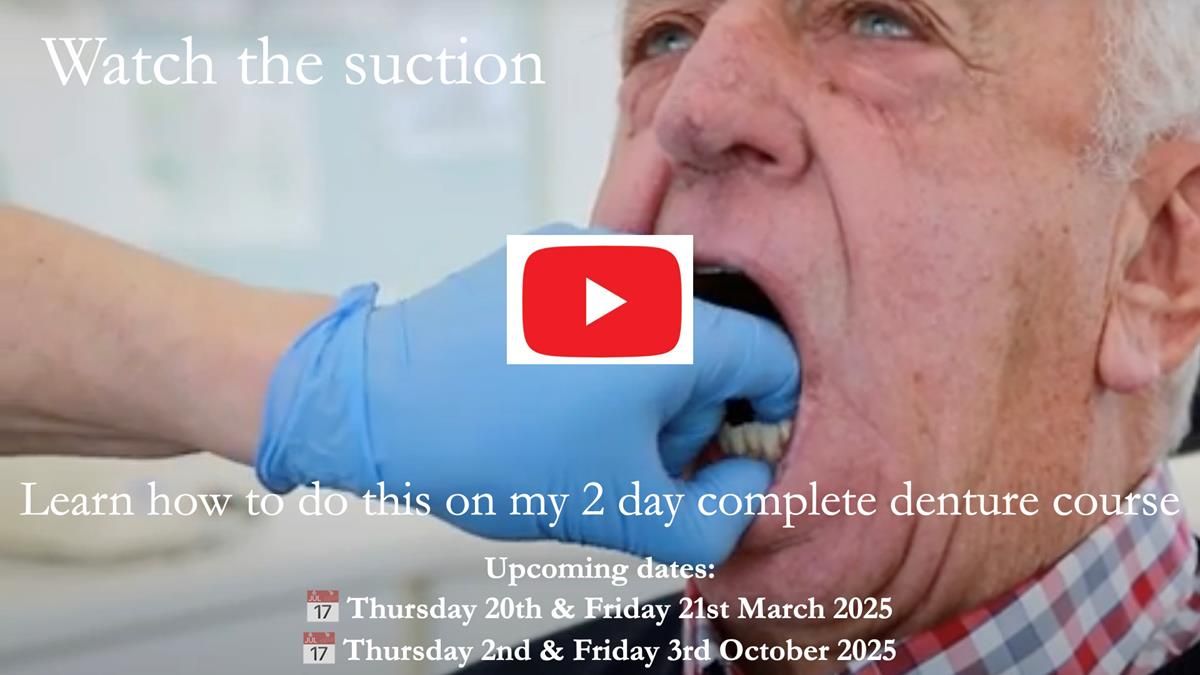 Newsletter 80 - Gordon’s dentures: the one case in 1,000 where my technique failed