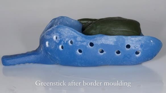 Finlay's Newsletter 64 case study - provision of a Kennedy class 2 metal based Scandinavian RPD for Ian