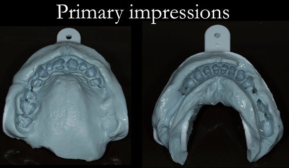Figure 14 Upper primary impression made with Dentsply Blueprint