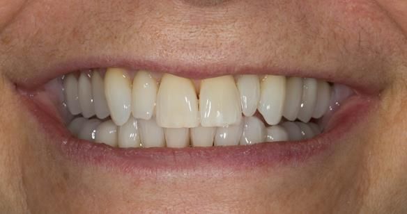 Figure 67 Teeth try in on pattern resin bases in the mouth. These help to confirm the accuracy of the working casts and the amount of metal work which will be visible in the final dentures