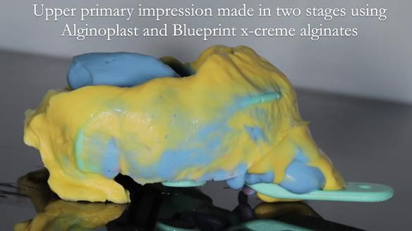 Finlay's Newsletter 60 Sylvia's upper Kennedy Class 2 Mod 1 metal based upper RPD