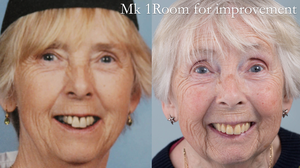 Figure 38 One week review after extractions - room for improvement aesthetically. the Immediate denture makes a good diagnostic appliance