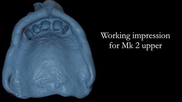 Finlay's Case Study Newsletter 40 - Immediate Mk 1 RPD to Definitive Mk 2 RPD - full protocol